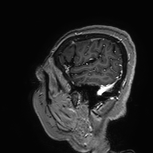 Cavernous hemangioma of the cerebellar falx (Radiopaedia 73025-83724 Sagittal T1 C+ 184).jpg