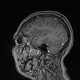 Cavernous sinus meningioma (Radiopaedia 63682-72367 Sagittal T1 C+ 125).jpg