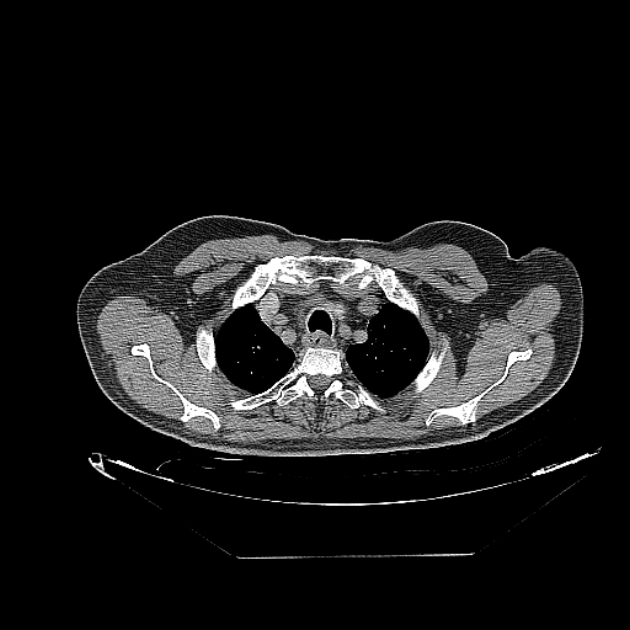 Cavitating bronchogenic carcinoma (Radiopaedia 44489-48162 Axial non-contrast 8).jpg