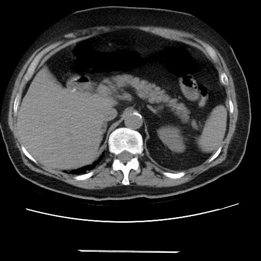 File:Cavitating pulmonary metastases (Radiopaedia 89545-106544 Axial non-contrast 57).jpg