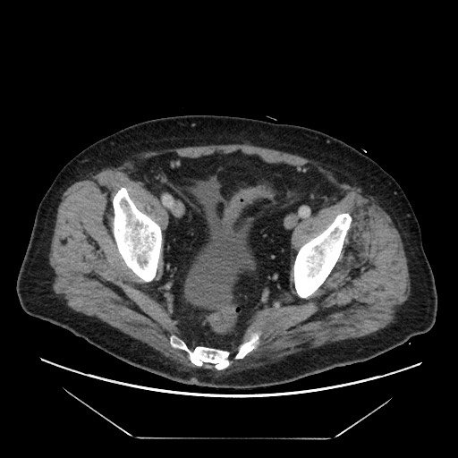 Cecal adenocarcinoma (Radiopaedia 64871-73817 A 83).jpg