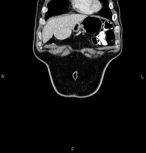 Cecal adenocarcinoma (Radiopaedia 85324-100916 D 5).jpg