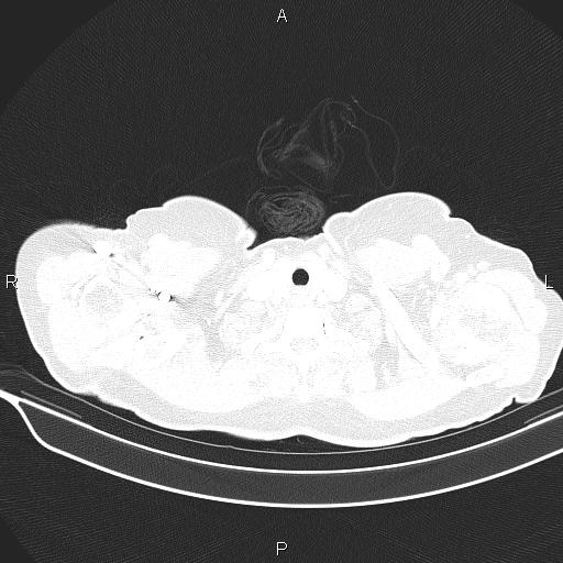Cecal cancer (Radiopaedia 85610-101358 Axial lung window 2).jpg