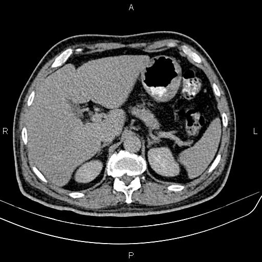 File:Cecal cancer with appendiceal mucocele (Radiopaedia 91080-108651 Axial C+ delayed 7).jpg