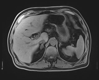 Cecal mass causing appendicitis (Radiopaedia 59207-66532 Axial T1 39).jpg