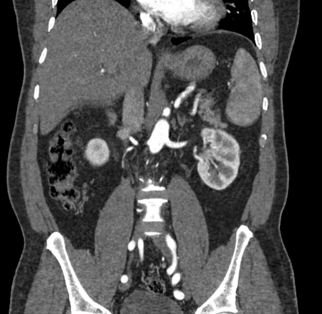 Celiac artery dissection (Radiopaedia 52194-58080 C 69).jpg