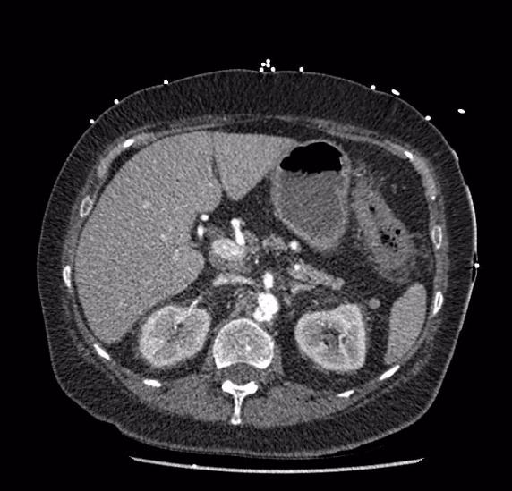 Celiac artery severe stenosis and dissection (Radiopaedia 44128-47842 B 27).jpg
