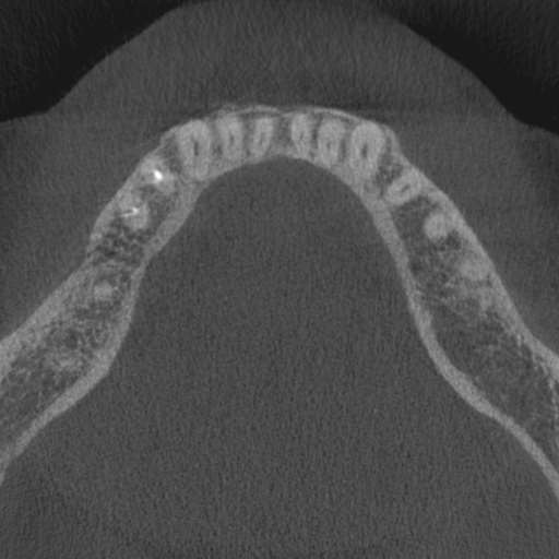 Cemento-osseous dysplasia (Radiopaedia 48251-53126 Axial non-contrast 35).jpg