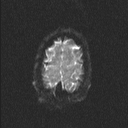 Central neurocytoma (Radiopaedia 56690-63469 Axial DWI 19).jpg