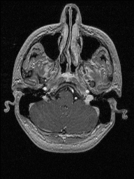 Central neurocytoma (Radiopaedia 56690-63469 Axial T1 C+ 32).jpg