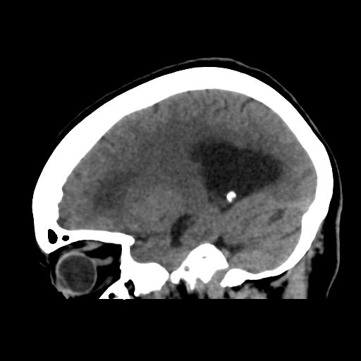 File:Central neurocytoma (Radiopaedia 65317-74346 C 37).png
