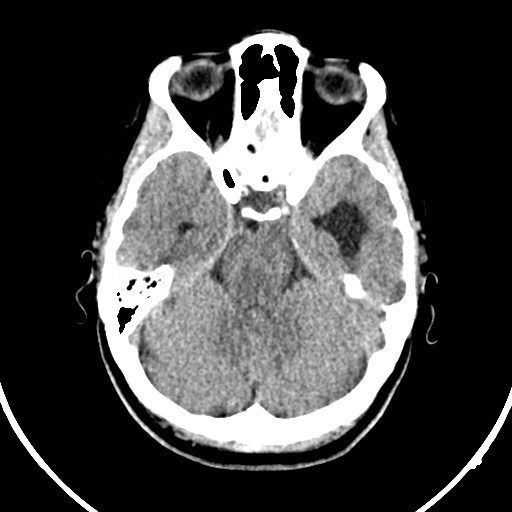 File:Central neurocytoma (Radiopaedia 84497-99871 Axial non-contrast 13).jpg