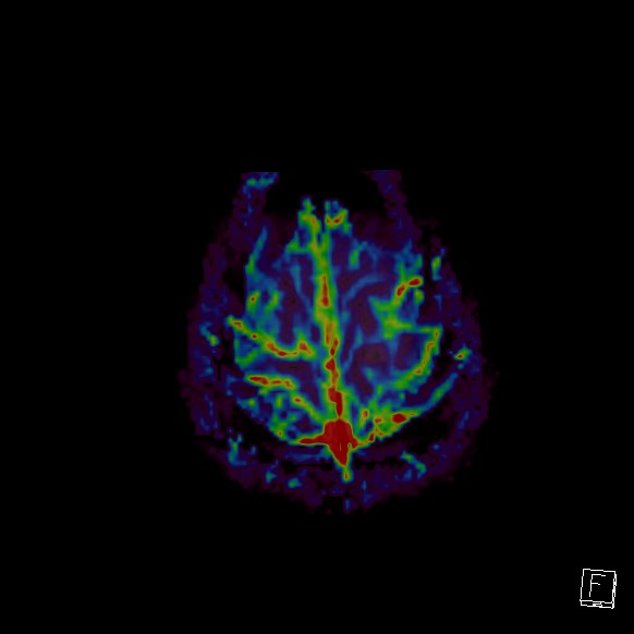 Central neurocytoma (Radiopaedia 84497-99872 Axial Perfusion 27).jpg