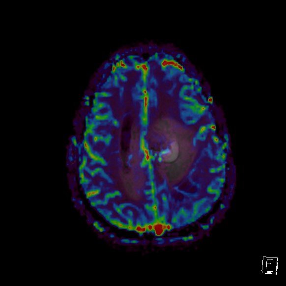 Central neurocytoma (Radiopaedia 84497-99872 Axial Perfusion 83).jpg