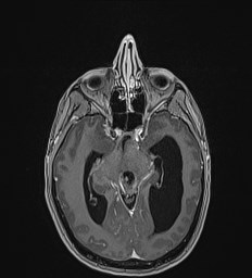 Central neurocytoma (Radiopaedia 84497-99872 Axial T1 C+ 63).jpg