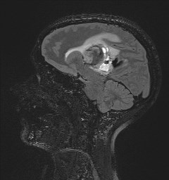 Central neurocytoma (Radiopaedia 84497-99872 Sagittal Flair + Gd 89).jpg
