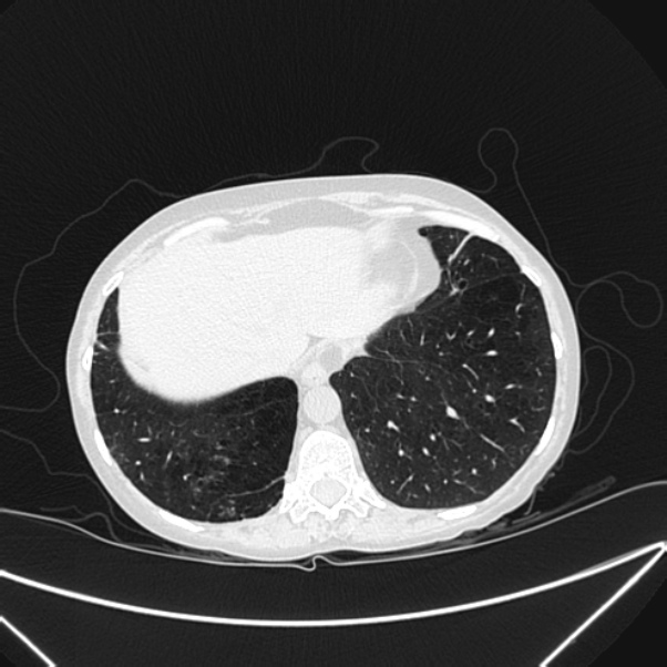 Centrilobular pulmonary emphysema (Radiopaedia 24495-24789 Axial lung window 78).jpg
