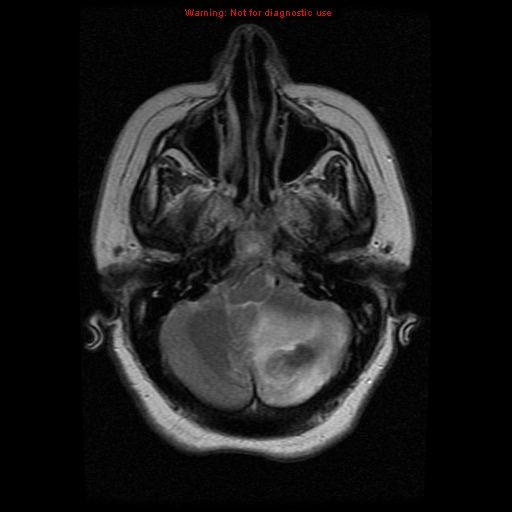 File:Cerebellar abscess (Radiopaedia 10845-11275 Axial T2 1).jpg