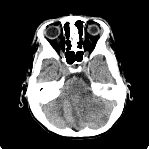 Cerebellar abscess secondary to mastoiditis (Radiopaedia 26284-26412 Axial non-contrast 39).jpg
