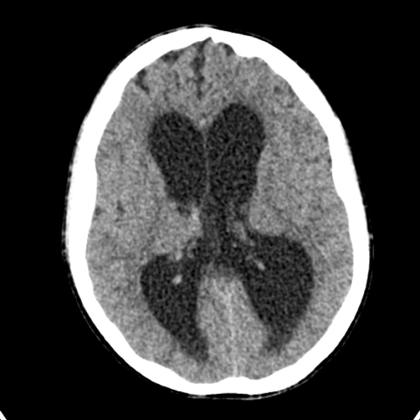Cerebellar abscess secondary to mastoiditis (Radiopaedia 26284-26412 Axial non-contrast 87).jpg