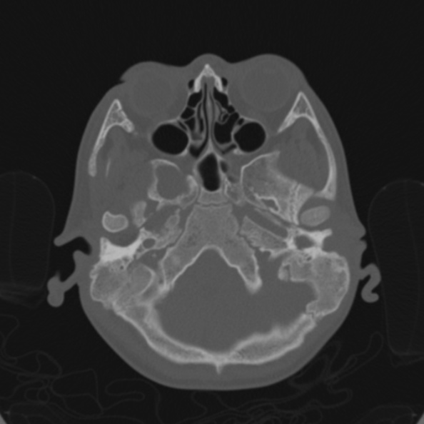 Cerebellar abscess secondary to mastoiditis (Radiopaedia 26284-26413 Axial bone window 35).jpg