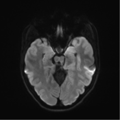 Cerebellar agenesis with hypoplastic pons (pontocerebellar hypoplasia) (Radiopaedia 57224-64138 Axial DWI 51).png