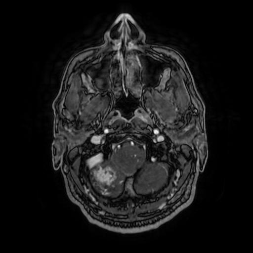 Cerebellar hemangioblastoma (Radiopaedia 88055-104622 Axial T1 C+ 34).jpg