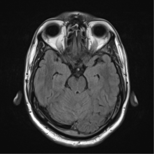 File:Cerebellar hemangioblastomas and pituitary adenoma (Radiopaedia 85490-101176 Axial FLAIR 11).png