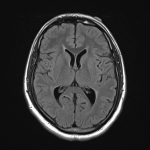 File:Cerebellar hemangioblastomas and pituitary adenoma (Radiopaedia 85490-101176 Axial FLAIR 16).png