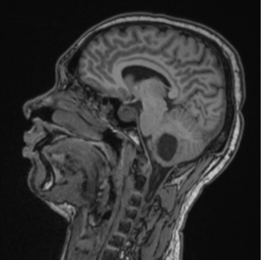 File:Cerebellar hemangioblastomas and pituitary adenoma (Radiopaedia 85490-101176 Sagittal T1 56).png