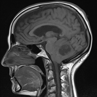 File:Cerebellar metastases (Radiopaedia 24038-24249 Sagittal T1 9).jpg