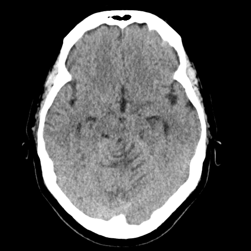 File:Cerebellar metastasis (Radiopaedia 54578-60812 Axial non-contrast 19).png