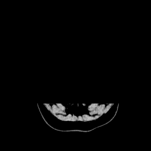 Cerebellar metastasis (cystic appearance) (Radiopaedia 41395-44258 Axial non-contrast 3).png