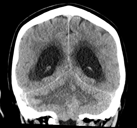 File:Cerebellar metastasis from lung adenocarcinoma (Radiopaedia 86690-102828 Coronal non-contrast 27).png