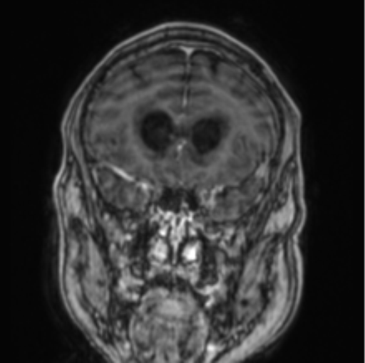Cerebellar metastasis from lung adenocarcinoma (Radiopaedia 86690-102829 Coronal T1 C+ 70).png