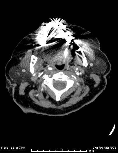 File:Cerebellar strokes due to intracranial giant cell arteritis (Radiopaedia 68799-78510 CT angiogram 86).jpg