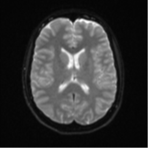 Cerebellar tuberculomas (Radiopaedia 46939-51472 Axial DWI 17).png