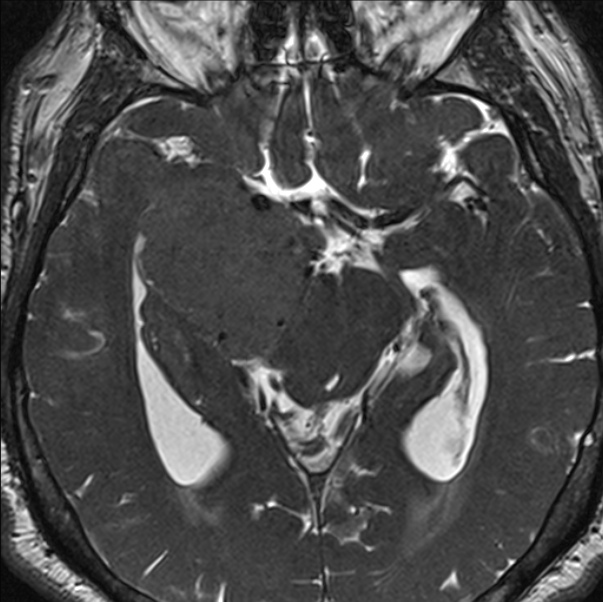 Cerebellopontine angle meningioma (Radiopaedia 24459-24764 I 43).jpg