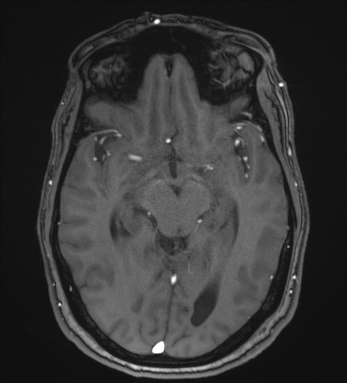 Cerebellopontine angle meningioma (Radiopaedia 72983-83680 Axial MRA 54).jpg
