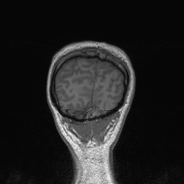 Cerebral abscess (Radiopaedia 24212-24478 Coronal T1 179).jpg