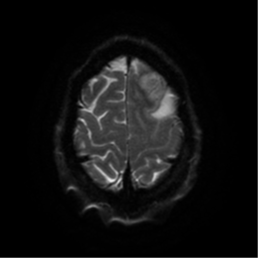 Cerebral abscess (Radiopaedia 57774-64740 Axial DWI 54).png