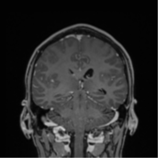 Cerebral abscess (Radiopaedia 60342-68009 H 18).png