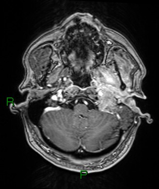 Cerebral abscess and subdural empyema (Radiopaedia 84436-99779 Axial T1 C+ 73).jpg