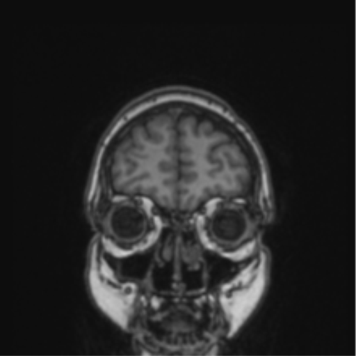 File:Cerebral abscess from pulmonary arteriovenous malformation (Radiopaedia 86275-102291 Coronal T1 77).png