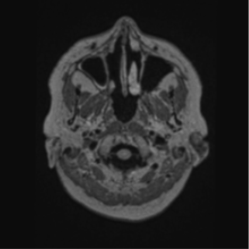 Cerebral abscess from pulmonary arteriovenous malformation (Radiopaedia 86275-102291 J 7).png