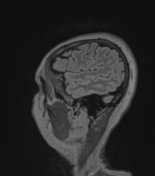 Cerebral abscess from pulmonary arteriovenous malformation (Radiopaedia 86275-102291 Sagittal FLAIR 13).png
