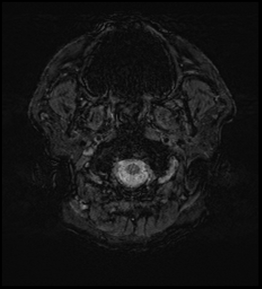 Cerebral abscess with ventriculitis (Radiopaedia 78965-91878 Axial SWI 3).jpg
