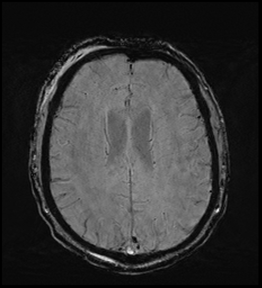 Cerebral abscess with ventriculitis (Radiopaedia 78965-91878 Axial SWI 35).jpg