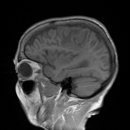 File:Cerebral amyloid angiopathy-related inflammation (Radiopaedia 74836-85849 Sagittal T1 11).jpg