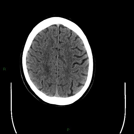 Cerebral amyloid angiopathy (Radiopaedia 77506-89665 Axial non-contrast 82).jpg
